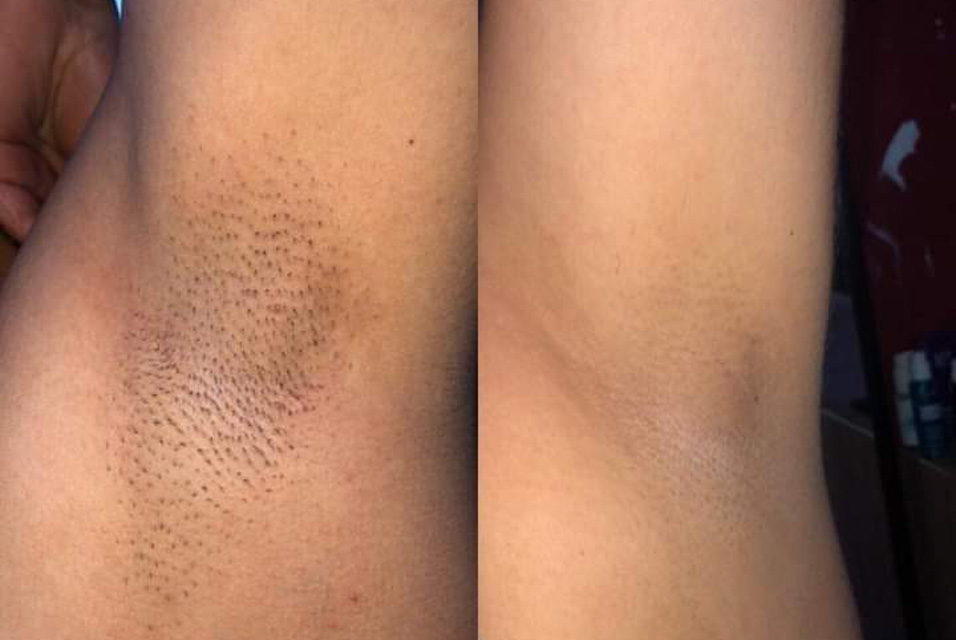 Epilation definitive avec EpilPro