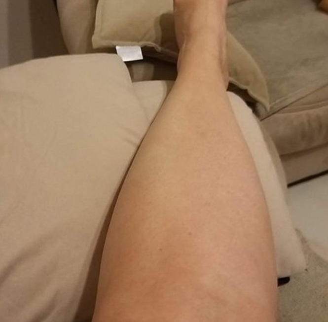 epilation definitive